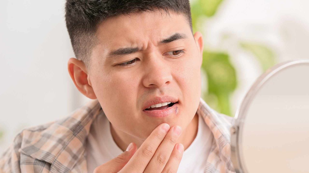 how to get rid of a cold sore in 24 hours