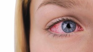Symptoms and Characteristics of a Subconjunctival Hemorrhage